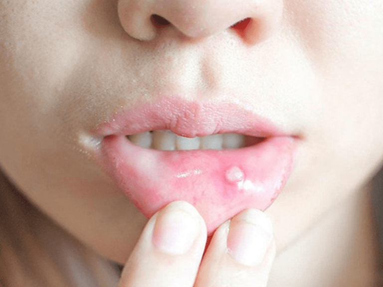 Mouth Ulcers Causes Treatments And When To See A Doctor Atenderdentalcare