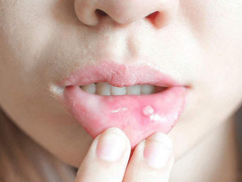 mouth-ulcers-causes-treatments-and-when-to-see-a-doctor